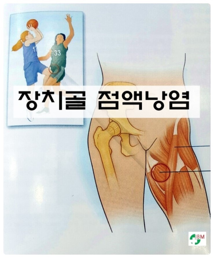 장치골 점액낭염/강릉 강남통증클리닉