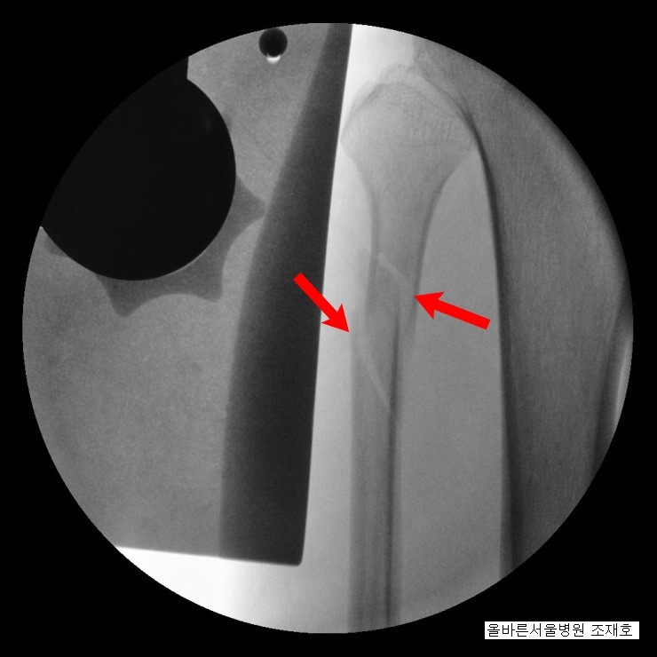 artroză 2 3 grade a articulației genunchiului inflamația lichidului sinovial al genunchiului