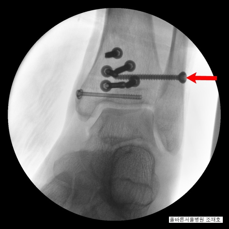 osteocondroza articulațiilor genunchiului 1 grad